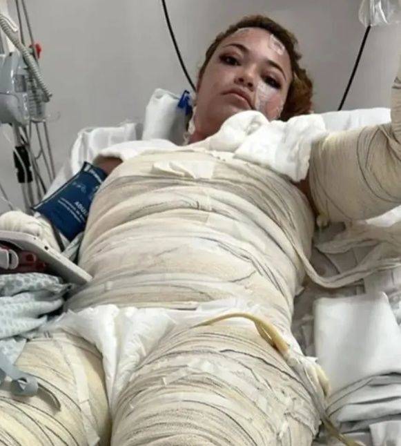 [서울=뉴시스] 브라질에서 온수 목욕 사고로 인해 전신에 3도 화상을 입은 가브리엘 크리스틴 바레토 데 프라이타스(24·여)는 병원 치료를 받다 심정지로 사망했다. (사진=더 선 캡처) 2025.06.10 *재판매 및 DB 금지