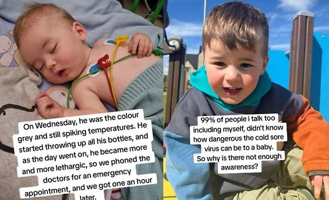 어느 날 갑자기 고열로 시작된 증상은 단순포진 바이러스로 인한 뇌염 진단으로 이어졌다. 현재 세 살인 제드는 매일 반복되는 발작 증상과 발달 지연을 겪고 있다. [사진=SNS]