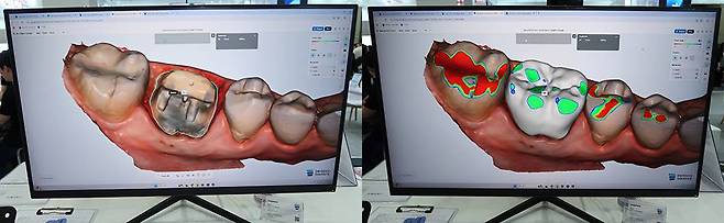 덴트버드는 치아와 잇몸의 경계, 보철물 형태를 자동으로 설정한다 / 출처=IT동아
