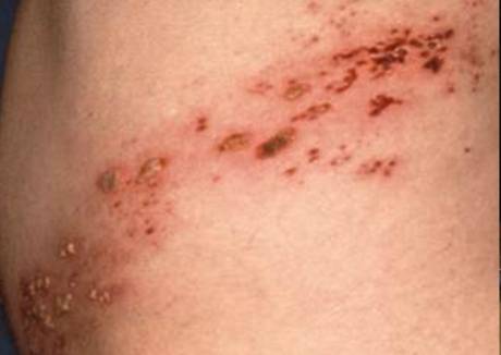 대상포진 이미지./사진=미래본병원