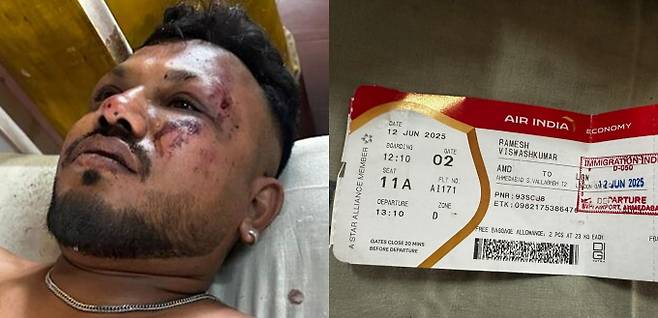 에어인디아 여객기 추락 사고 생존자 모습이 현지 언론 등에 공개됐다. 사진은 지난 12일(현지시각) 에어인디아 여객기 추락 사고의 유일한 생존자 라메쉬 비슈와스쿠마르 부하르바디의 모습. /사진=힌두스탄타임스 캡처