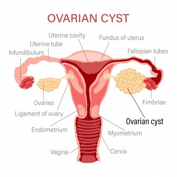 난소 낭종(ovarian cyst) 자료 이미지. 아이클릭아트