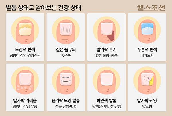발톱 상태별 의심할 수 있는 건강 상태/그래픽=김민선
