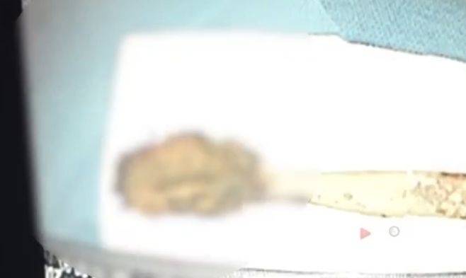 중국 안후이성 64세 양모 씨 몸에서 제거된 길이 15cm 짜리 칫솔. 양씨는 흉부 통증이 심해져 병원에서 CT를 찍은 결과 52년 전 장난삼아 삼킨 칫솔을 발견했다. [중국왕]