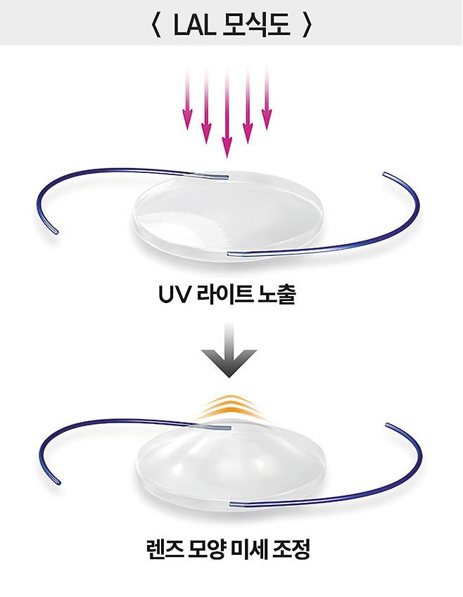 LAL(광조절 인공수정체) 렌즈 내부에는 자외선(UV 라이트)에 반응하는 물질이 들어있다. 수술 후 렌즈에 전용 기기로 빛을 쏘면 렌즈 모양이 바뀐다. 이 원리로 환자 맞춤형 시력을 구현 할 수 있다. /센트럴서울안과 제공