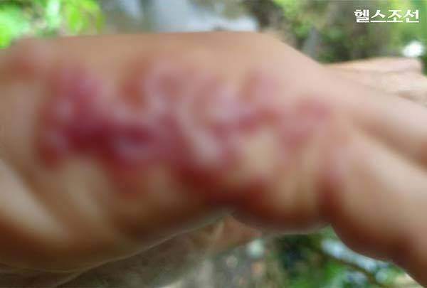 태국의 한 남성이 야외에서 잡초를 제거하던 중 피부에 기생충이 침투해, 손에 물집이 무더기로 생긴 사연이 전해졌다./사진=페이스북 캡처