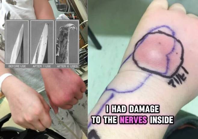 의사의 주사 바늘 재사용으로 인해 고통스러운 병을 얻었다는 여성의 사연이 소개됐다. 그는 소독하지 않은 주사 바늘을 반복적으로 꽂는 과정에서 뼈나 신경을 건드려 감염이 발생했을 것으로 추정하고 있다. [사진=SNS]