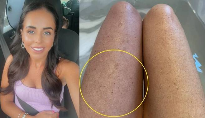 매일 먹던 피임약으로 인해 다리에 혈전이 생긴 여성의 사연이 소개됐다. [사진=SNS]