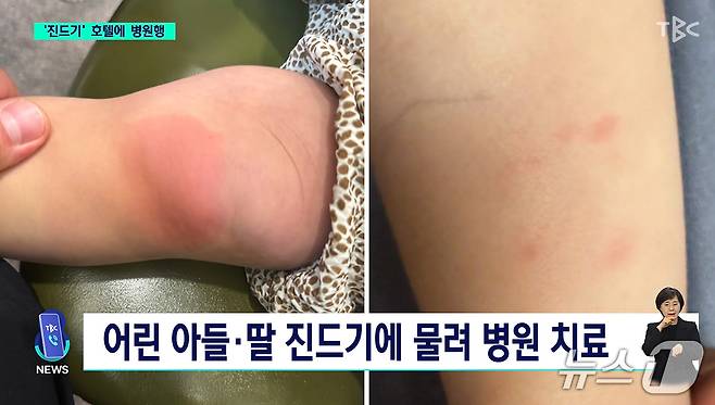 대구의 한 호텔 방에서 진드기가 발견됐다. (TBC 화면 갈무리)