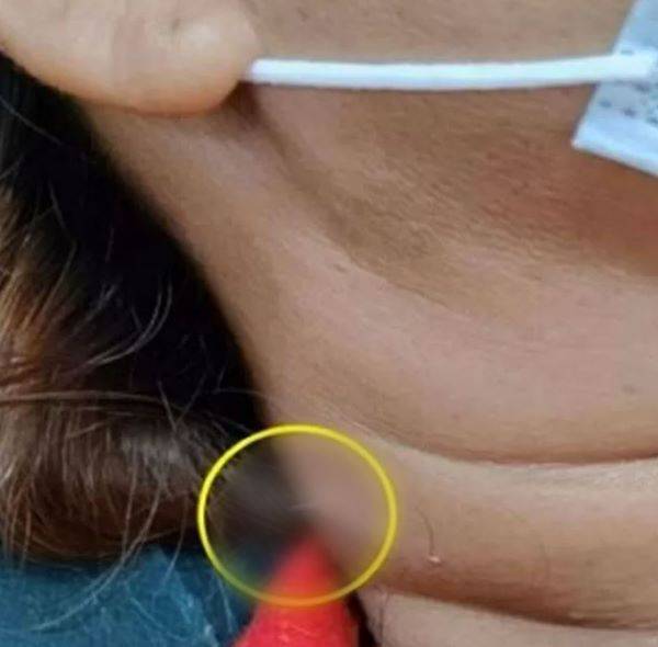 생선국을 먹고 2주 뒤 피부를 뚫고 나온 가시. /사진=워크포인트 뉴스