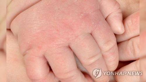 아기 손 사진은 기사 본문과 직접 관련이 없음.[연합뉴스 자료사진]