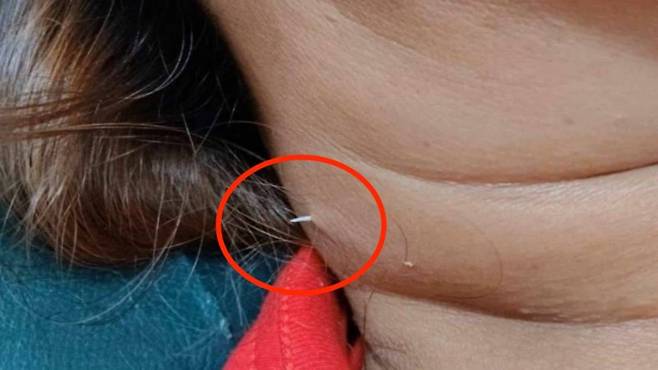 [뉴시스] 태국에서 40대 여성이 식사 중에 삼킨 생선가시가 목을 관통해 피부 밖으로 돌출됐다. (사진=페이스북) /사진=뉴시스