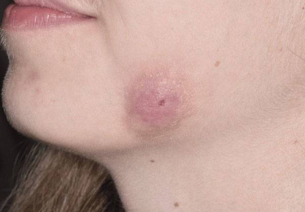 사랑니 발치 후 합병증으로 누공(두 개의 빈 공간 사이의 비정상적인 연결)​이 생긴 18세 여성의 모습./사진=큐레우스