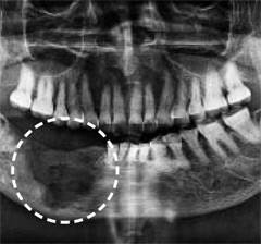 골다공증 치료제 투여 부작용으로 턱뼈가 괴사한 모습.  경향신문 자료사진