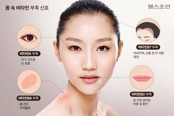 각종 비타민이 부족할 때 얼굴에 다양한 증상이 나타날 수 있다./그래픽=헬스조선