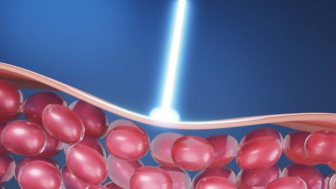 레이저. 게티이미지뱅크 제공