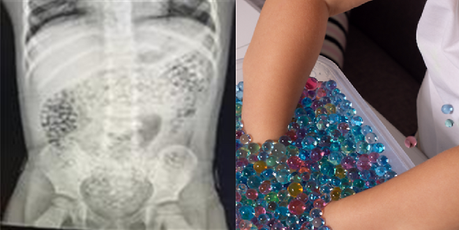 일명 '개구리알'로 불리는 수정토 장난감과 수정토를 삼킨 어린이 복부 엑스레이 촬영 사진. (한국소비자원·미국 소비자제품안전위원회 제공)