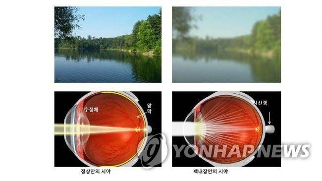 정상 눈과 백내장 눈의 시야 비교 [김안과병원 제공]