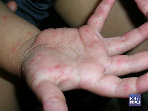 최근 수족구병 환자수가 증가하는 양상을 보이면서 27일 질병관리청(청장 지영미)은 영유아가 있는 가정 및 관련 시설에서의 위생수칙 준수를 당부했다. ⓒ베이비뉴스