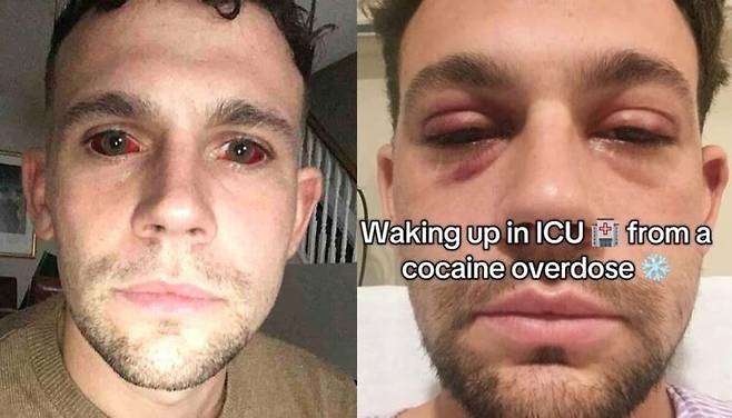 15년간 코카인 중독에 빠져있던 한 남성이, 5일 연속 코카인을 흡입했다가 겪은 경험담을 공유했다. [사진=SNS]
