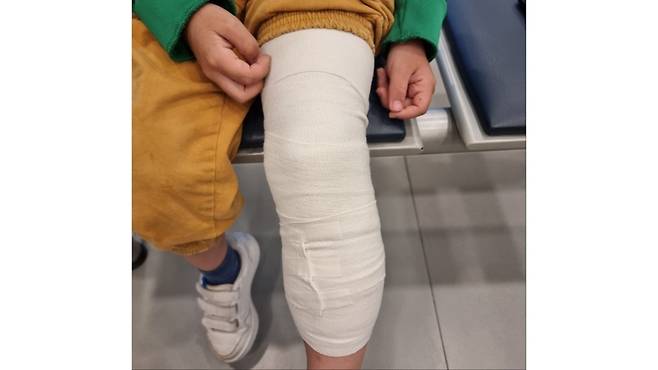 무릎이 골절돼 전치 8주 진단을 받은 A 군