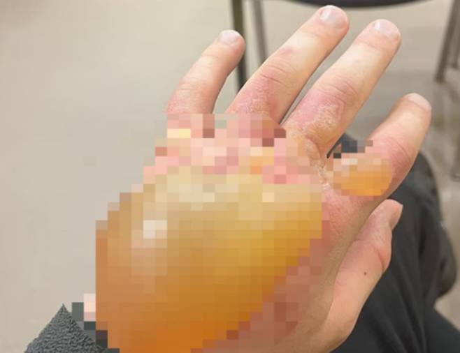 큰멧돼지풀을 만진 영국의 한 남성 손에 큰 물집이 잡혀있다./사진=데일리메일 캡처