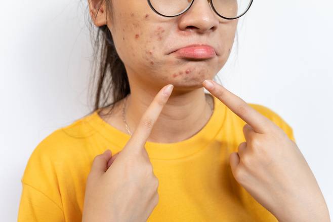 베트남의 한 10대 여성이 얼굴에 난 여드름을 손으로 짜고 출처가 불분명한 연고를 바른 뒤 심각한 감염 증상으로 사망하는 사건이 발생했다. *사진은 직접적 관계 없음 [사진=게티이미지뱅크]