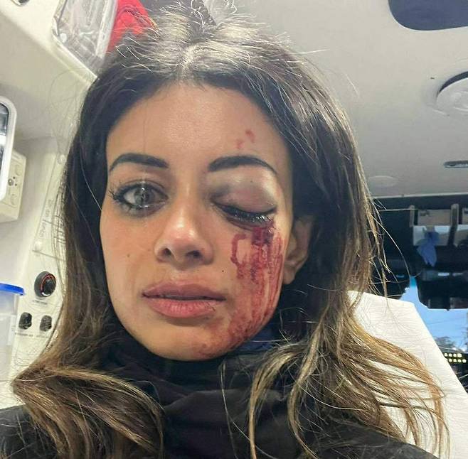 팔레스타인 지지 시위 중 다친 호주 정치인 해나 토머스 [SCMP 캡처. 재판매 및 DB 금지]