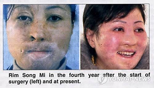 북한 여성 노동자의 성형수술 전후 사진     (서울=연합뉴스) 북한의 주간 영자신문이 2015년 공개한 사례. 2006년 평안북도 대관군의 공장 화재로 심각한 얼굴 화상을 당한 여성 노동자 림송미(28)가 8년에 걸친 성형수술로 외모를 회복했다. 평양타임스는 림송미의 4년 전과 현재의 얼굴을 나란히 비교하는 사진도 게재했다.