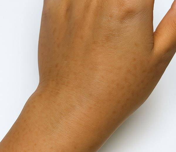 동남아 지역을 다녀온 뒤 손등에 갈색 반점이 생​기는 식물성광피부염을 겪는 사람이 많다./사진=AI 생성 이미지