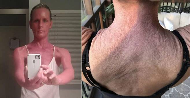 유년기부터 습진을 앓았던 50대 여성이 30년간 쓰던 스테로이드제 사용을 중단한 뒤 머리부터 발끝까지 피부가 붉게 변하는 부작용을 겪었다. 스테로이드 연고를 장기간 사용하다 멈추면 스테로이드 금단 증후군이 생길 수 있다. [사진=SNS]