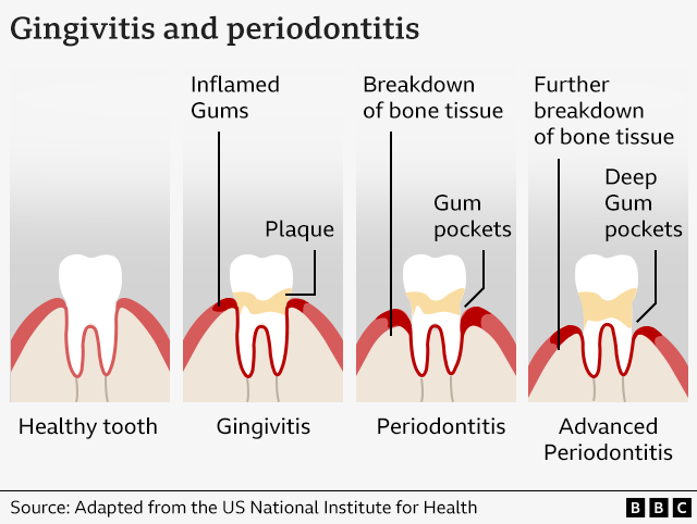 건강한 치아에서 잇몸 질환이 어떻게 진행되는지 보여주는 그래픽