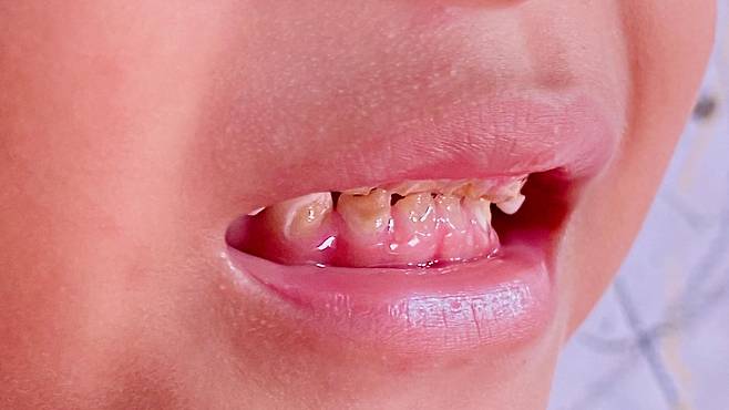 아울러 설탕이 많은 음식과 음료는 어린이뿐 아니라 성인에게도 충치를 유발할 수 있다