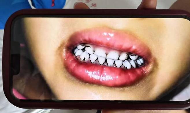 중국서 납중독 의심으로 치아 일부가 검게 변한 유치원생. 연합뉴스