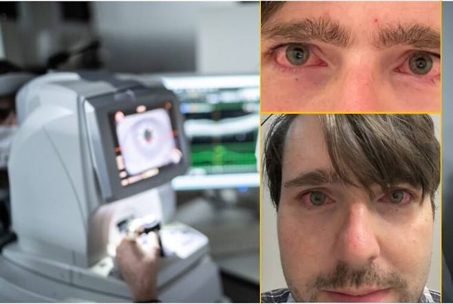 영국에서 레이저 시력교정술을 받은 한 응급구조요원이 실명 위기에 처하고, 만성 안구 통증에 시달리는 사례가 알려졌다.[사진=게티이미지뱅크/우측 네이선 클라우=SNS]