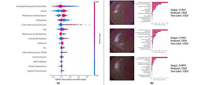 사진은 설명 가능한 AI 기법을 통한 주요 위험 인자 기여도 시각화 결과다. (사진=경희대 제공) *재판매 및 DB 금지