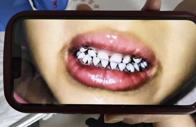 중국 간쑤성 톈수이의 한 유치원에 다니는 아동의 잇몸이 식품첨가물에 의한 납중독으로 검게 변한 모습.  위챗 캡처