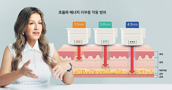 사브리나 파비 박사는 “초음파 리프팅의 효과를 높이려면 각 피부층에 정확히 열 응고점을 형성해야 한다”며 “이를 위해서는 환자 피부 구조와 깊이를 볼 수 있는 실시간 영상 기술이 중요하다”고 말했다. /그래픽=김민선·사진=사브리나 파비 박사 제공