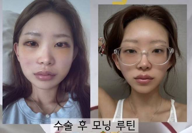 [서울=뉴시스] 최준희가 지난 7일 본인 인스타그램에 광대, 눈 성형수술 후 사진을 공개했다. (사진=최준희 인스타그램 캡처) 2025.07.08. photo@newsis.com *재판매 및 DB 금지