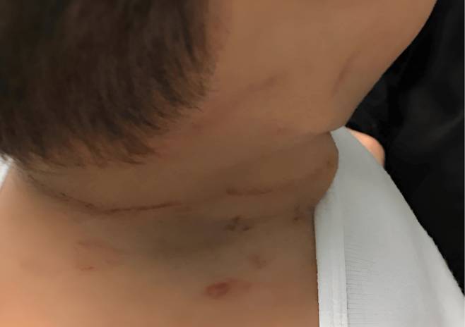 미국 아칸소에서 15개월 아기가 누나의 긴 머리카락에 목이 졸려 기절하는 사고가 발생했다. 빠른 응급조치로 무사히 회복했지만, 의료진은 긴 머리카락처럼 일상 속 물건도 영유아에겐 치명적일 수 있다며 주의를 당부했다. (사진=cureus)