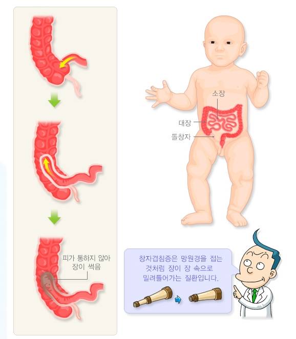 장중첩증이 생기는 과정. /자료=국가건강정보포털