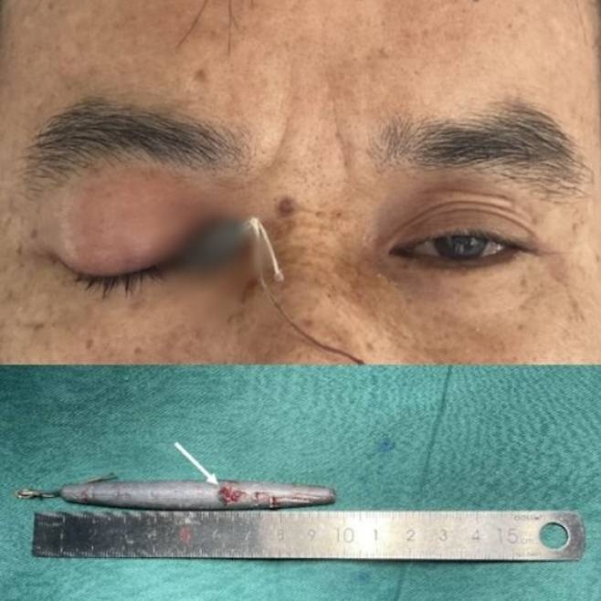 한 40대 중국 남성이 납으로 된 9cm 길이의 봉돌(낚싯대에 달린 무게 추)이 눈에 박히는 중상을 입는 사고를 입은 사례가 보고됐다. [사진=BMJ Case Reports]