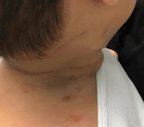 15개월 된 아기가 누나의 머리카락 위를 기어다니다가 머리카락에 목이 졸려 기도가 막히고 얼굴이 파랗게 질리는 청색증을 겪었다. 누나가 자세를 바꿀수록 머리카락은 아이의 목을 감았다. [사진=SNS]