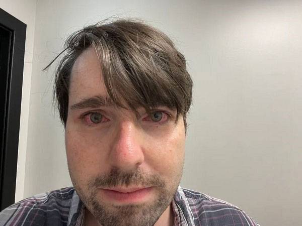 네이선 클로우(35)는 시력을 좋게 하려 라식 수술을 받았는데 오히려 눈이 충혈되고 극심한 건조증에 시달리게 됐다./사진=더 선