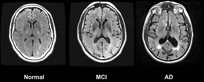 왼쪽부터 정상인, 경도인지장애(MCI), 알츠하이머병(AD)의 뇌. 위키미디어 코먼스
