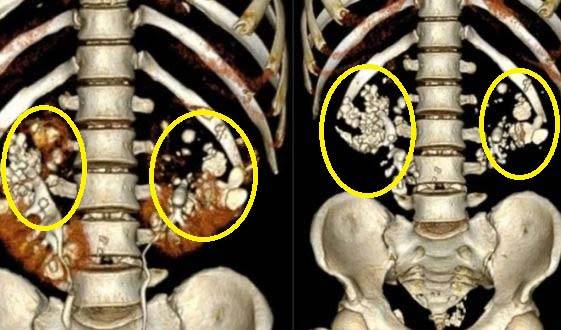 탄산음료 즐겨 마시다가 신장 결석 수백 개 생긴 남성의 CT스캔 사진/사진=VN익스프레스