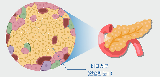 ‘췌장 문제’ 당뇨에 두 가지 약 함께 썼더니 기능 회복 효과