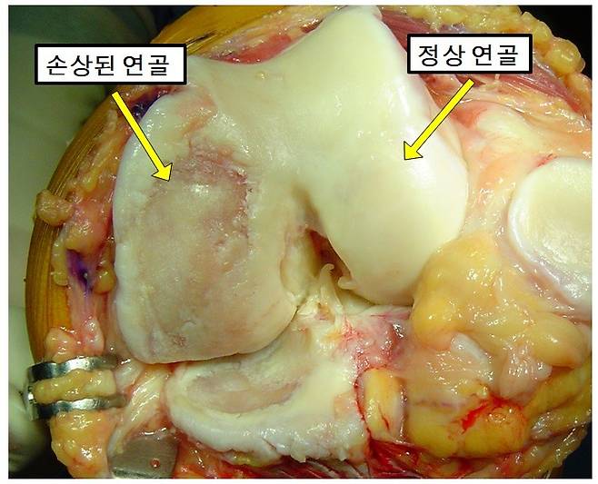 퇴행성 관절염으로 손상된 무릎 연골. [사진=송무호]