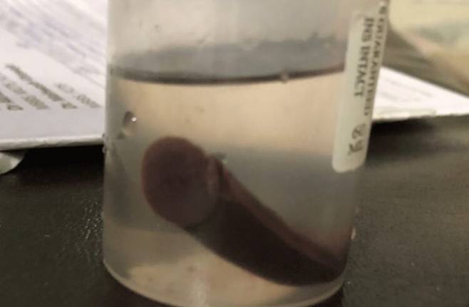 영국 남성(36)의 구강인두에서 끄집어낸 거머리. 크기가 7~8cm였다. [사진=영국 글렌필드병원 제공]