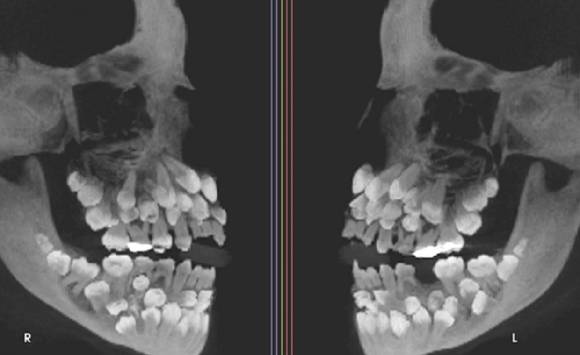'치아 81개'를 가진 사례가 학계에 보고됐다. 사진은 소녀의 엑스레이. [사진=미국 치과교정·악안면외과학회지(AJO-DO)]
